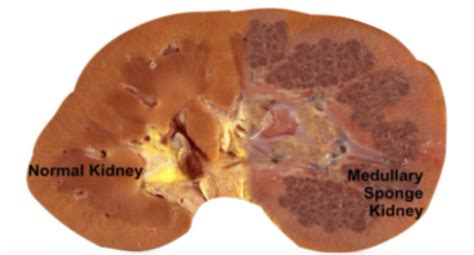 medullary sponge kidney disease diet.